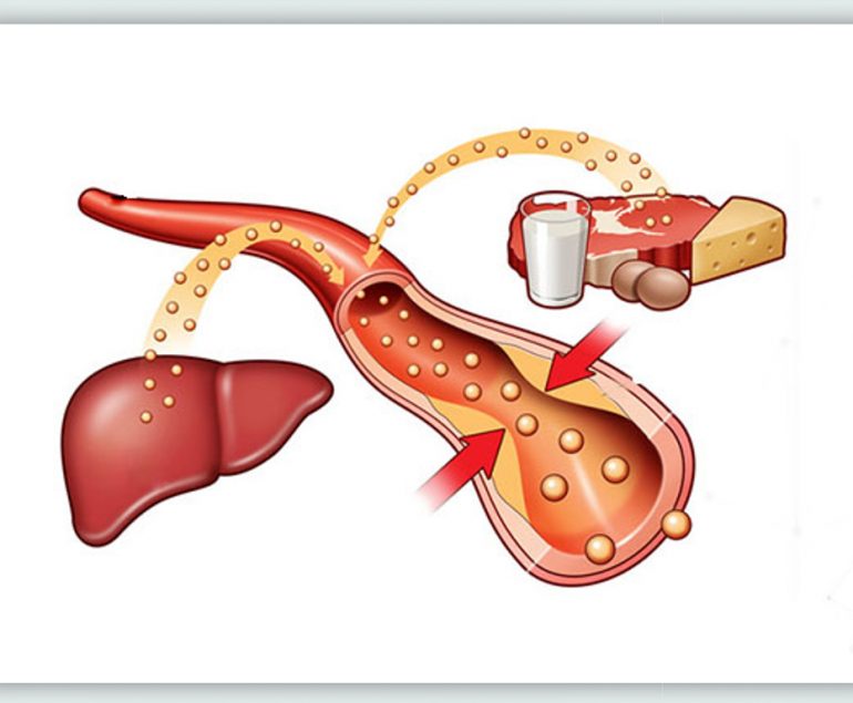 Hyperlipidemia Or High Cholesterol - Causes, Diagnosis And Treatment
